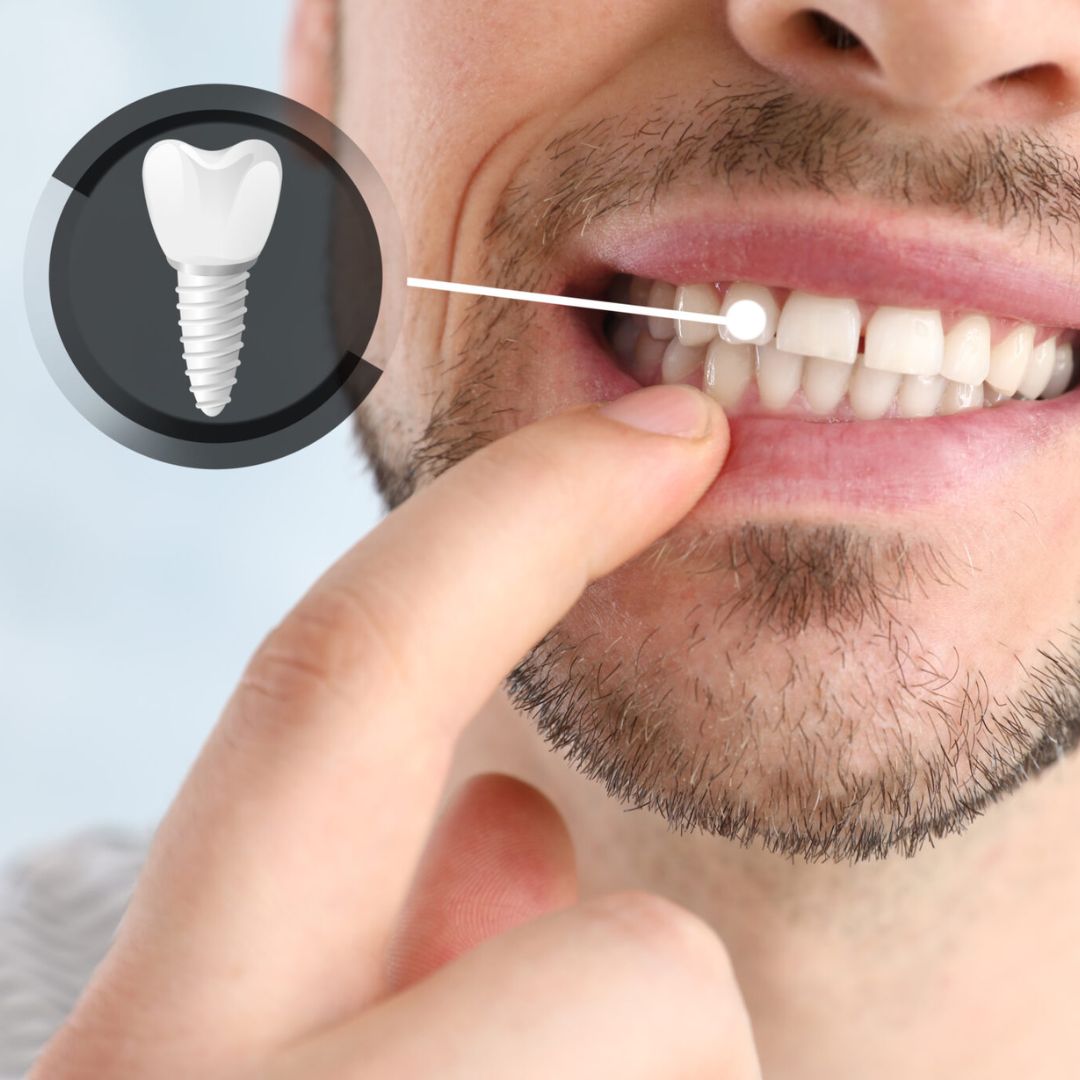 impianti dentali Chirurgo Orale dott monforte